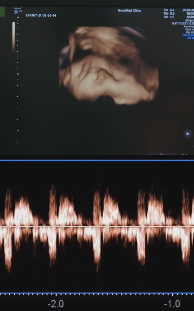 Video de Ecografía Animado — Eco Baby Live Frame™